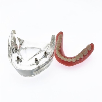 Model zębów dentystycznych z 4 implantami protezy
