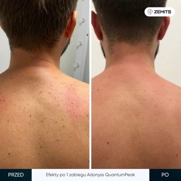 Аппарат Adonyss QuantumPeak с технологией ELOS для фотоомоложения