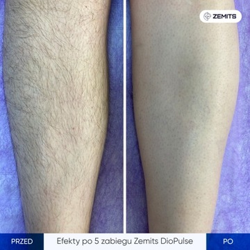 Adonyss DioPulse 808 Диодный лазер для эпиляции