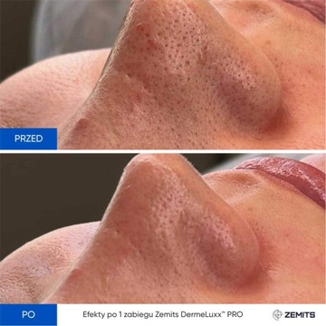 Аппарат Zemits DermeLuxx Pro для водной дермабразии и инфузии кислорода