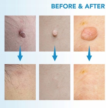 2 в 1 набор для автоматического удаления меток с кожи Micro Skin Tag