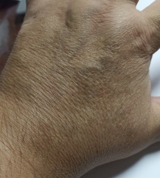 Antidote Aqua - Омоложение рук