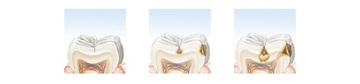 elmex CARIES Зубная паста от кариеса 2x75 мл