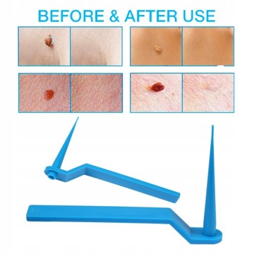 Tag skóry Zabij opaska do usuwania brodawek