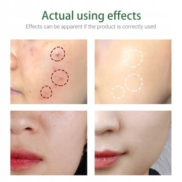 Очищающее средство для лица от прыщей на лице Linhuihui