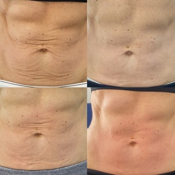 КАВИТАЦИОННАЯ УЛЬТРАЗВУКОВАЯ ЛИПОСАКЦИЯ RF 40K MINI