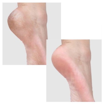 Нож для удаления мозолей Нож для педикюра