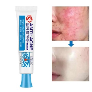 30 г мощного крема для лица от прыщей, удаляющего прыщи