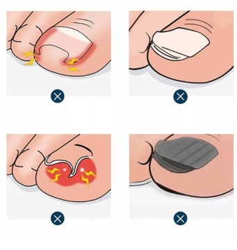 ЩИПЦЫ ДЛЯ ВРАСТНЫХ НОГТЕЙ БОЛЬШИЕ КЛИПЕРЫ ДЛЯ ВРАСТНЫХ НОГТЕЙ