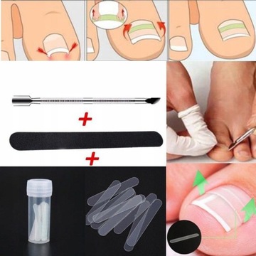 Пластыри для исправления вросших ногтей. Оформление ногтей