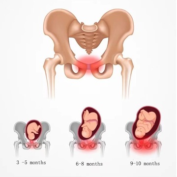 ПОЯС ДЛЯ БЕРЕМЕННОСТИ, ПОДДЕРЖИВАЮЩИЙ ЖИВОТ, ОБЛЕГЧАЮЩИЙ ПОЗВОНОЧНИК – ОБЛЕГЧЕНИЕ БОЛИ