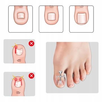 НАБОР ДЛЯ ВРАСТАНИЯ НОГТЕЙ НА ПАЛЬЦАХ ПАЛЬЦЕВ, КУСАЧКИ ДЛЯ РУКИ