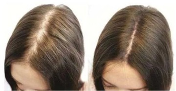 ДЕРМА РОЛИК для волос для роста волос уменьшает облысение кожи головы