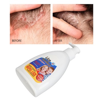 Шампунь от вшей 300 мл Очищение кожи головы Против 0У