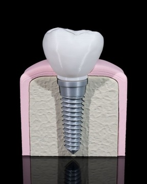 Model Stomatologiczny Implanta