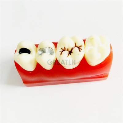 Dental Pit i szczelina uszczelniająca leczenie zę