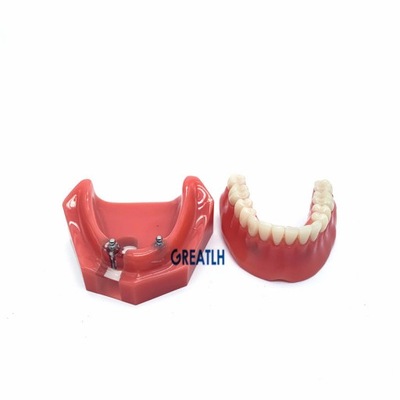 2 Implant Overdenture gorszy Model zębów Dental s