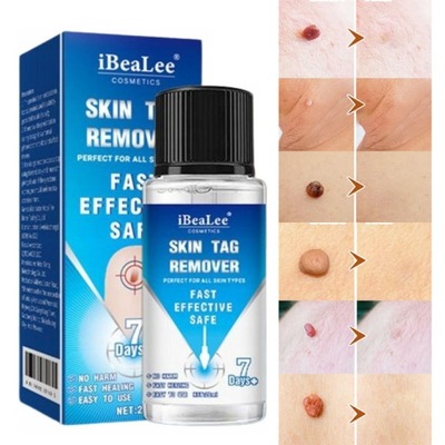 Silny płyn do usuwania włókniaków, kurzajek, brodawek 20ml