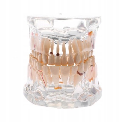 Powiększony ludzki model patologiczny zębów z