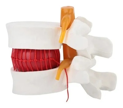 Model anatomiczny kręgosłupa, przepuklina dysku