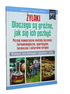 Żylaki dlaczego są groźne, jak się ich pozbyć