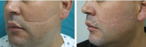 Revitol Scar Cream от старых шрамов и растяжек ШАНС!