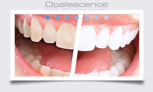 OPALESCENCE GO 20* ТАПЫ С ОТБЕЛИВАЮЩИМ ГЕЛЕМ