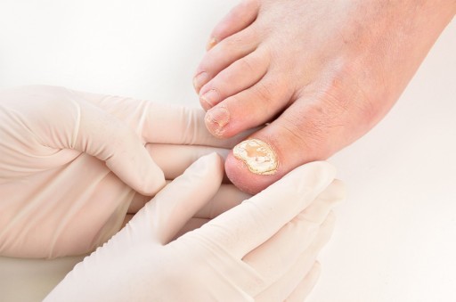 JAYSUING Nail Fungus 100 мл осветляющий спрей от грибка ногтей