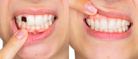 Зубные имплантаты Happy Smile Cosmetic