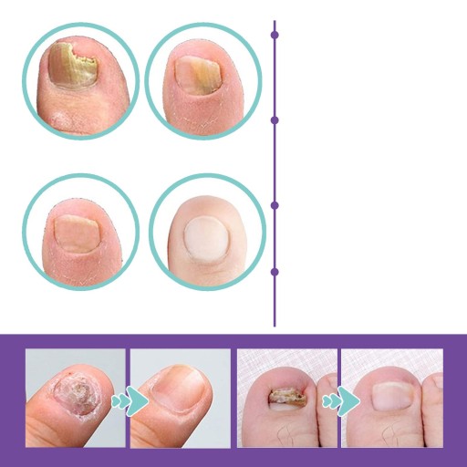 JAYSUING Nail Fungus 100 мл осветляющий спрей от грибка ногтей