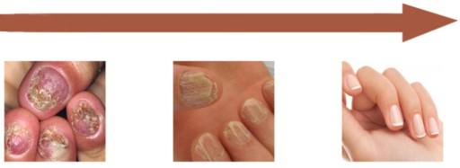 Грибок ногтей Strong Nail Repair Liquid JoyPretty 20мл