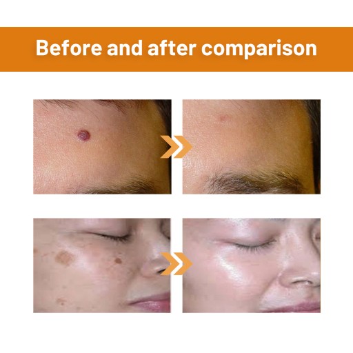 Лечение бородавок пчелиным ядом Hidradenitis Suppurativa Spray Remove средство