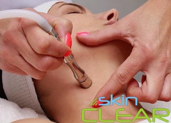 SKINCLEAR АЛМАЗНАЯ МИКРОДЕРМАБРАЗИЯ МОЩНОСТЬ 110 Вт