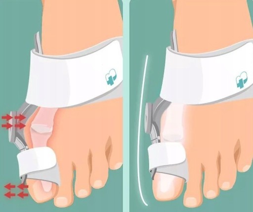 АКТИВНЫЙ КОРРЕКЦИОН ДЛЯ Ортеза HALLUX PRO корсет