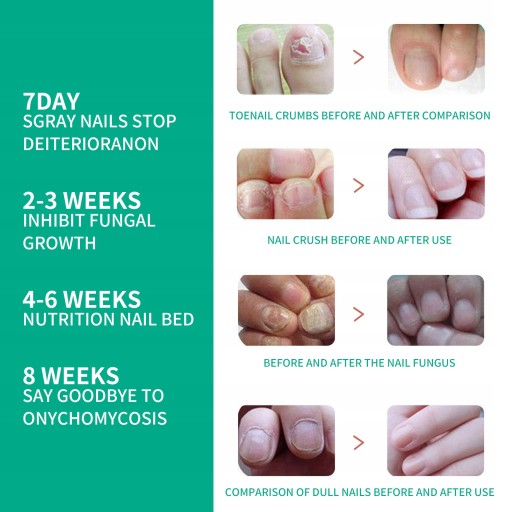 OUHOE Nail Repair Essence Nail