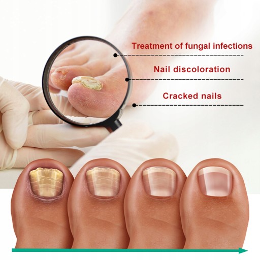 OUHOE Nail Repair Essence Nail