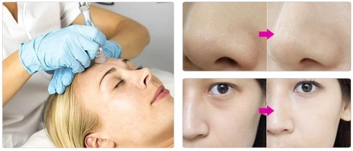 SKINCLEAR АЛМАЗНАЯ МИКРОДЕРМАБРАЗИЯ МОЩНОСТЬ 110 Вт