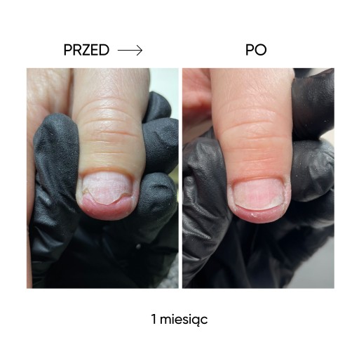 NOTD Onistop регенерирующее масло при онихолизисе