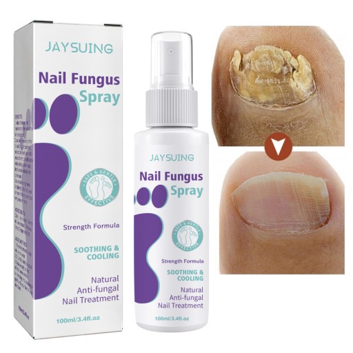 JAYSUING Nail Fungus 100 мл осветляющий спрей от грибка ногтей