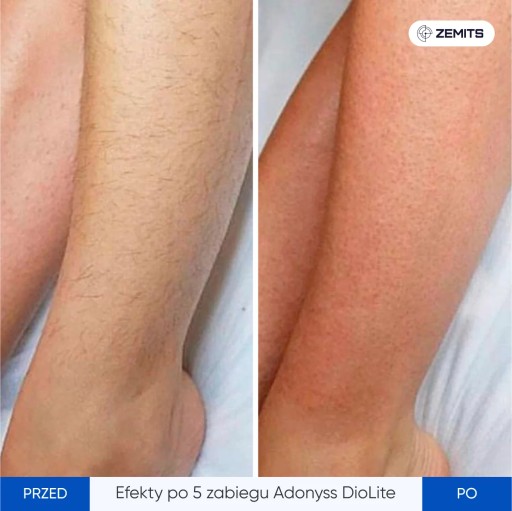 Портативный диодный лазер Adonyss DioLite для эпиляции