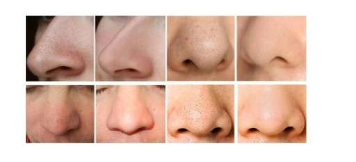 ПЫЛЕСОС для долота WĄGRÓW MICRODERMABRASION FREE