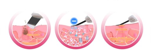 SKINCLEAR БЕСПРОВОДНОЙ КАВИТАЦИОННЫЙ ПИЛИНГ +БОНУС